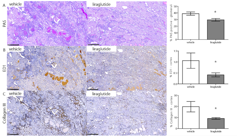 Proof of Concept: GLP-1RA Treatment Attenuates Renal Pathology in SDT Fatty Rat