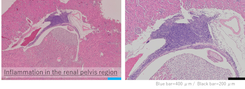 腎盂領域における炎症　病理組織