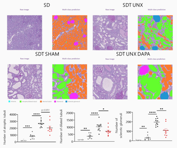 Nephropath Al demonstrates that dapagliflozin reduces tubuli impairment and glomerulosclerosis in Unx SDT fatty rats