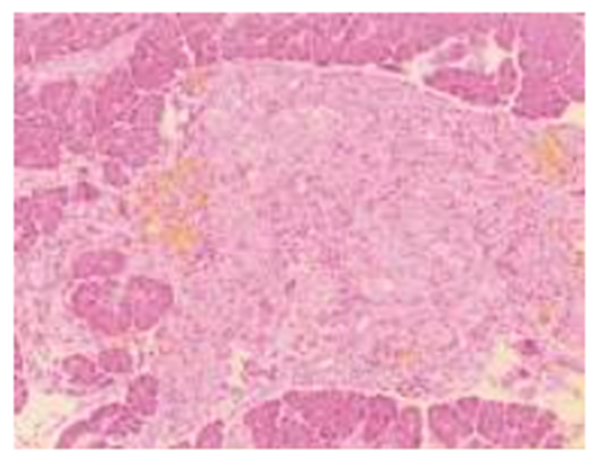 Figure-5 . Histopathological findings of the pancreas of a male SDT rats (25 weeks of age)