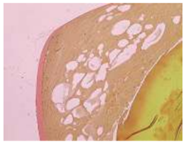 Figure-6 . Histopathological findings of the lens of a male SDT rat (40 weeks of age)