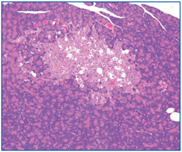 Figure-4 . Histopathological findings in pancreas of male SDT fatty rat (13 weeks of age)