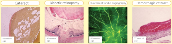 Diabetic retinopathy