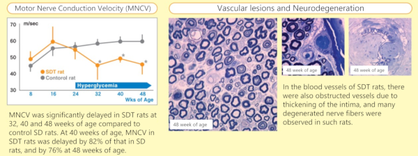 Diabetic neuropathy (Motor nerve conduction velocity)
