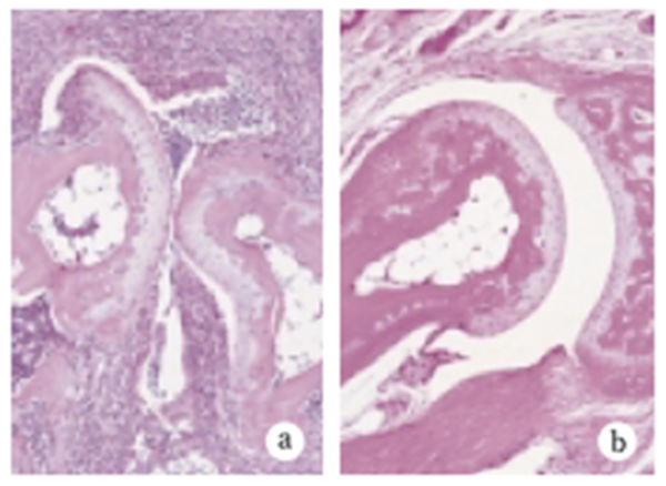 Fig.3 Historogy of joint swelling